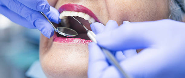 Best Emergency Dentist for Lost Fillings or Crowns in Montclair State University, NJ